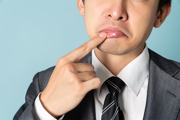 「口唇ヘルペス」を繰り返している人に知ってほしいこと