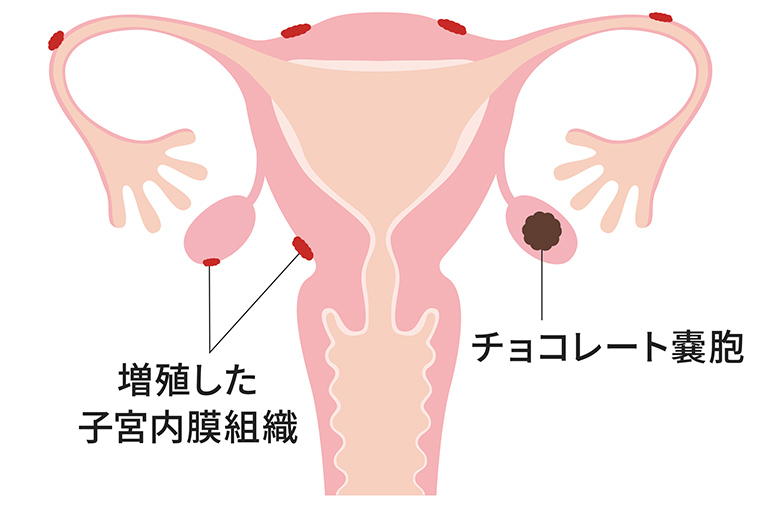 子宮内膜症
