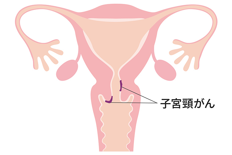 子宮頸がん