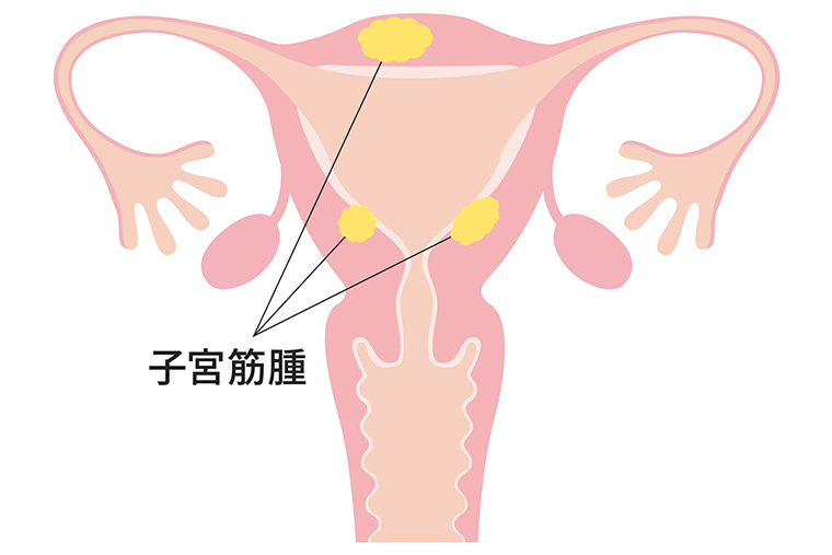 子宮筋腫
